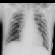 Cervical rib: X-ray - Plain radiograph